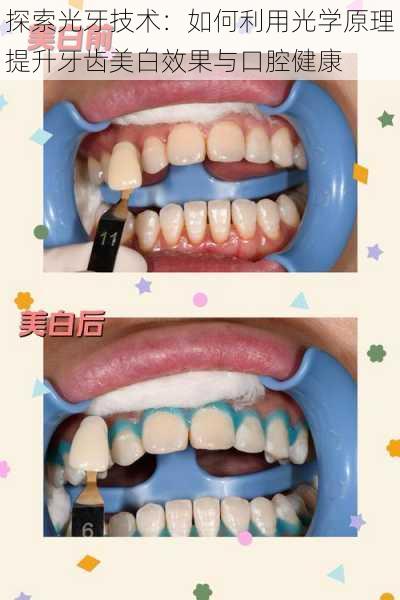探索光牙技术:如何利用光学原理提升牙齿美白效果与口腔健康